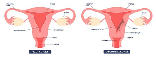 Gesunder und betroffener Uterus: Endometriumkarzinoms - ONKO-Kompakt